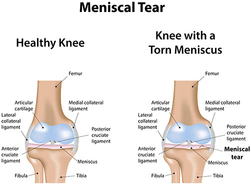 knee-meniscal